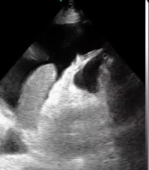 Derrame pleural