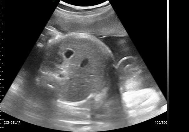 Abdome fetal