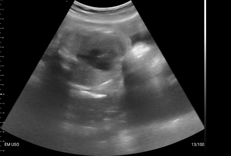 Batimento cardíaco fetal