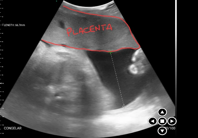 Placenta
