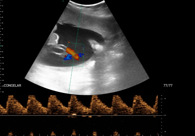 Doppler da a. umbilical