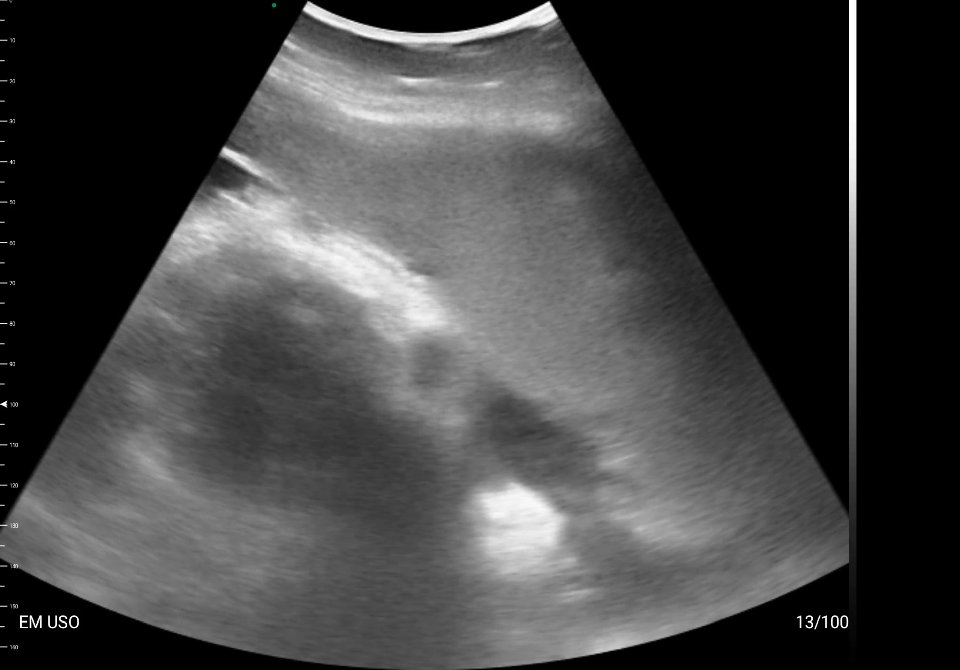 Polo cefálico fetal