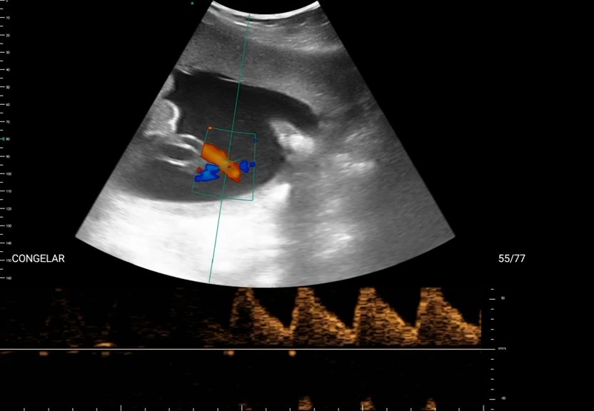 Doppler da a. umbilical